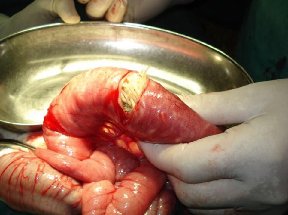 Spulwürmer im menschlichen Darm
